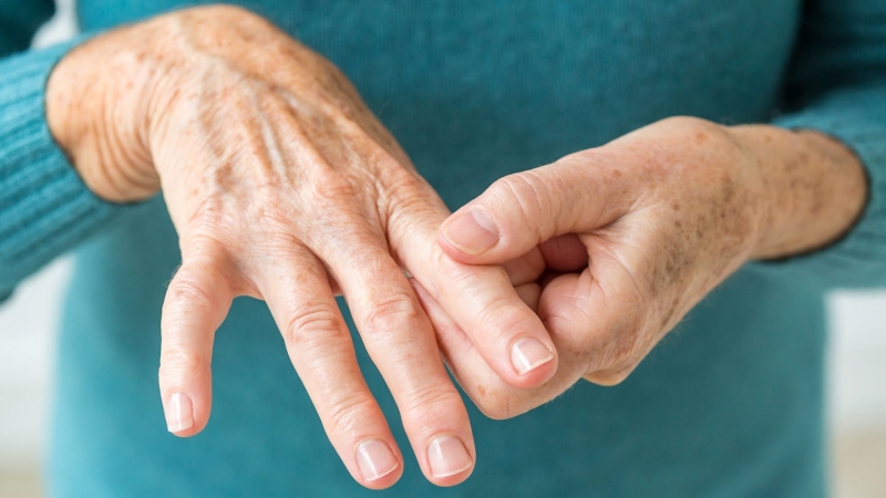 Rheumatoid Arthritis
