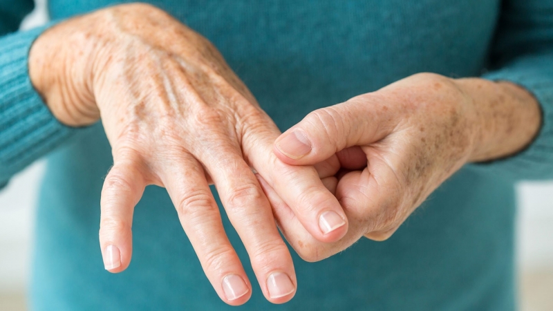 Rheumatoid Arthritis