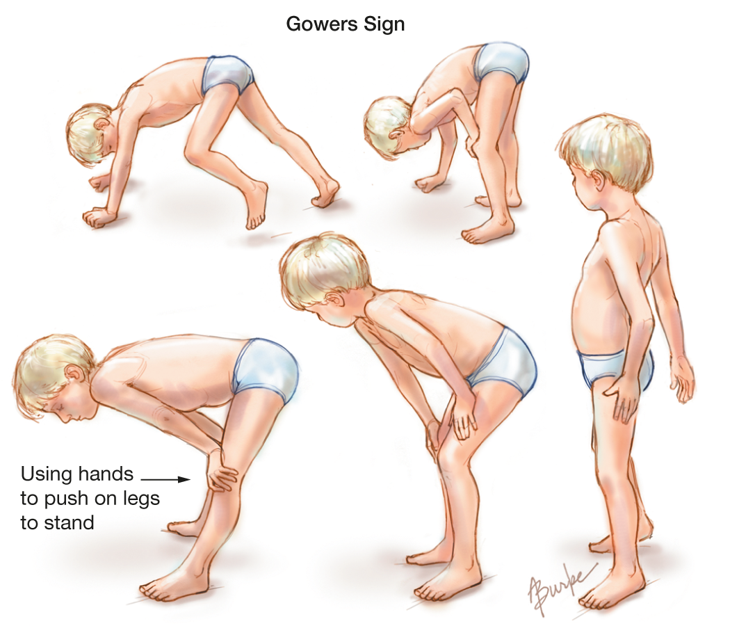 Muscular Dystrophy 