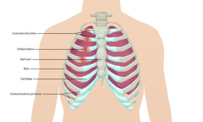 Costochondritis 