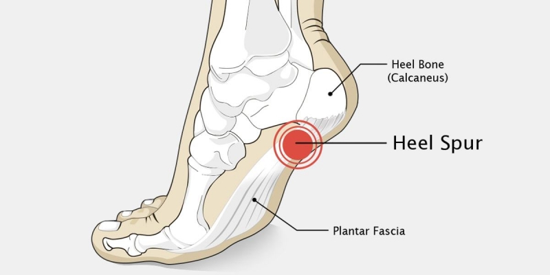 Treating Heel Spurs & Bone Spurs | Foot Health | Andrew Weil, M.D.
