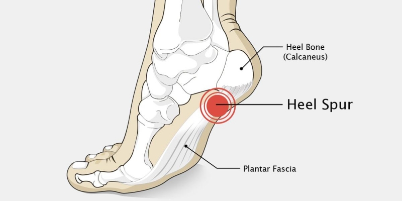 Calcaneal Spur