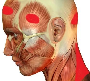 Cervicogenic Headache