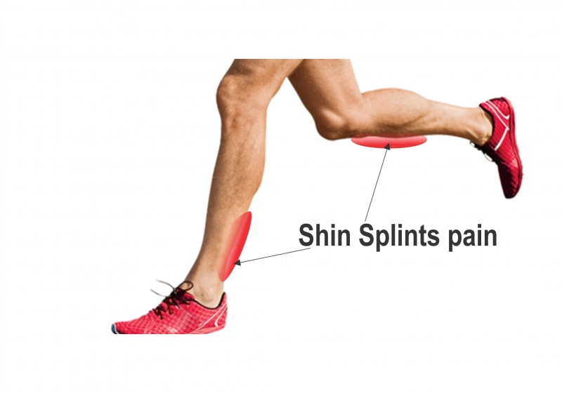 Shin Splint Pain Treatment In Gurgaon Dr Rajesh Pal Experienced