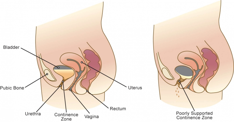 Stress Incontinence 