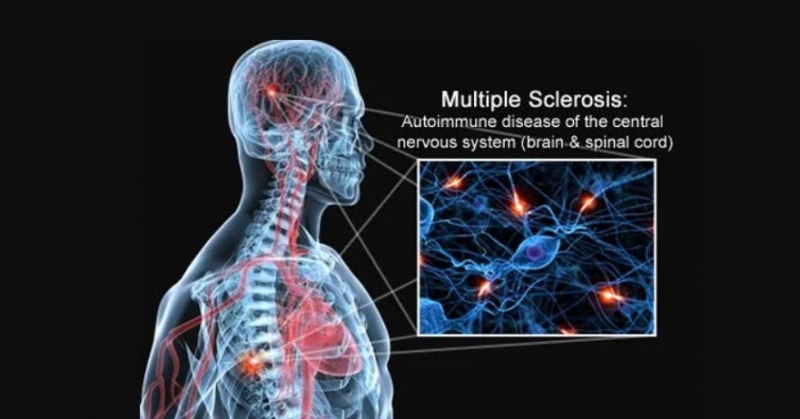 Multiple Sclerosis