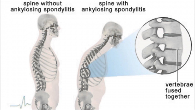 Ankylosing Spondylitis