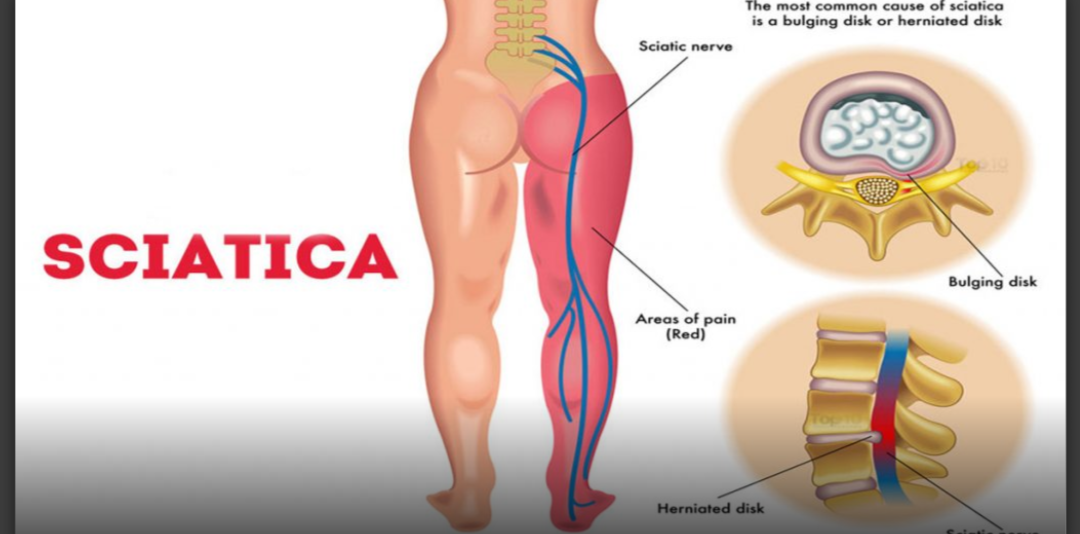 Sciatica