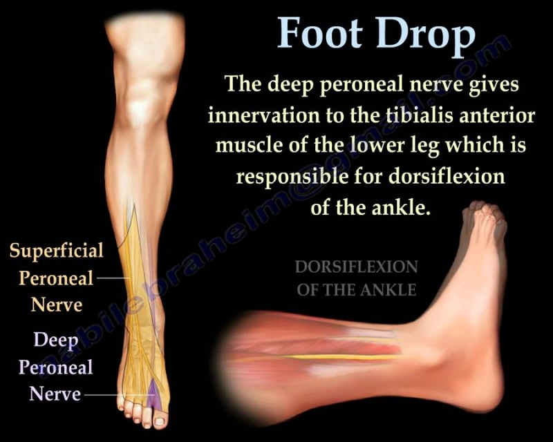 Neuromuscular Electrical Stimulation (NMES) for foot drop