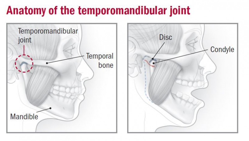 (TMD) Joint Dysfunction