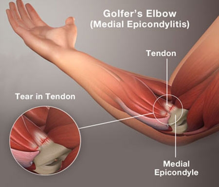 Tennis & Golfers Elbow