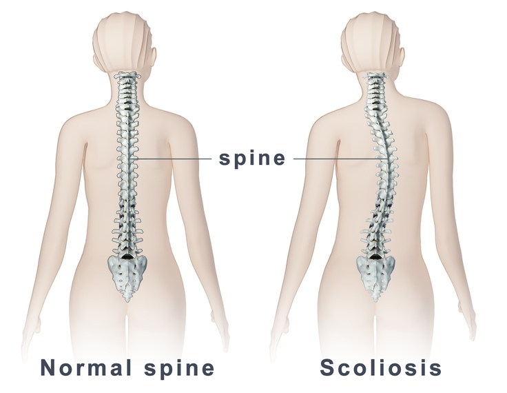 Scoliosis