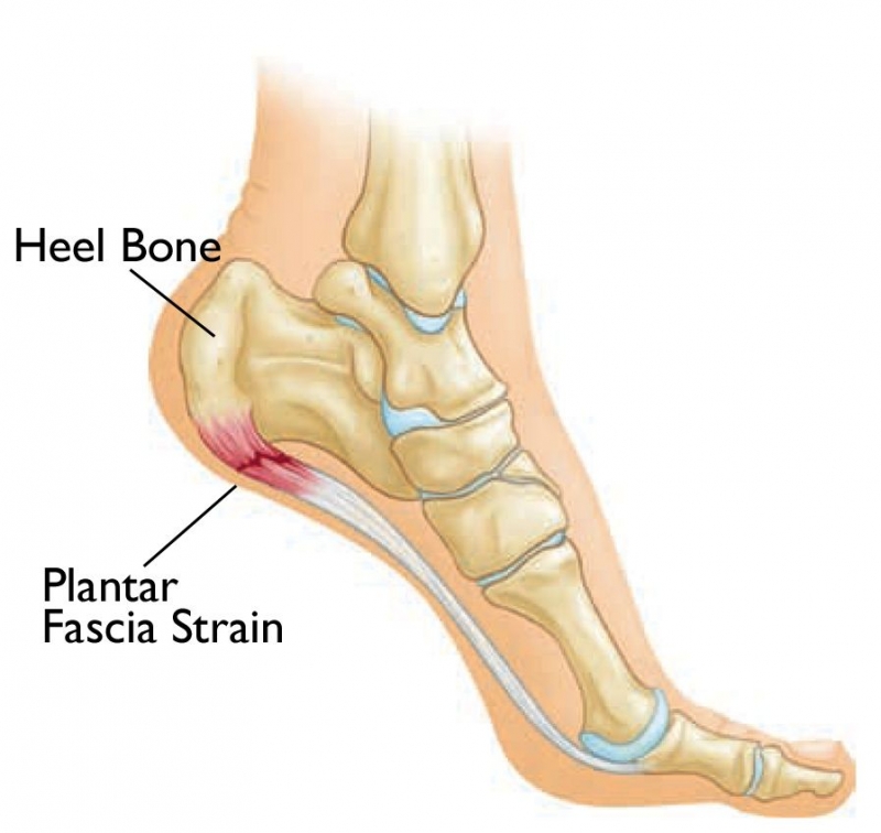 Plantar Fasciatis