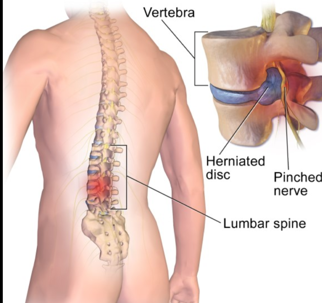 Slipped Disc