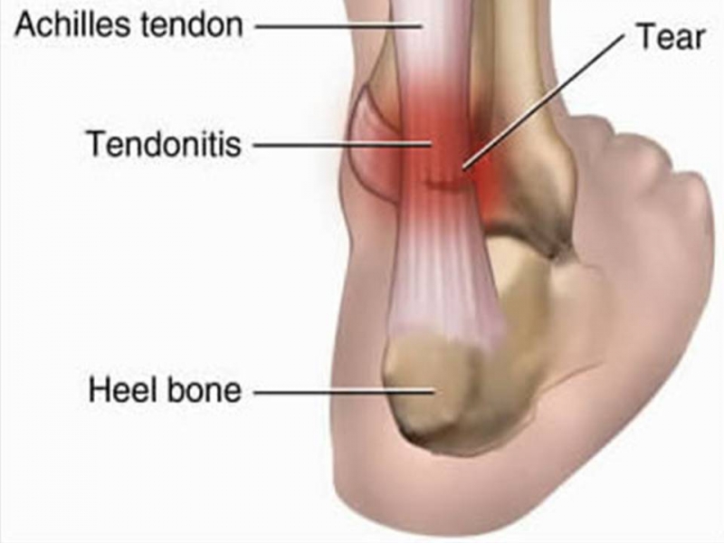 Tendonitis