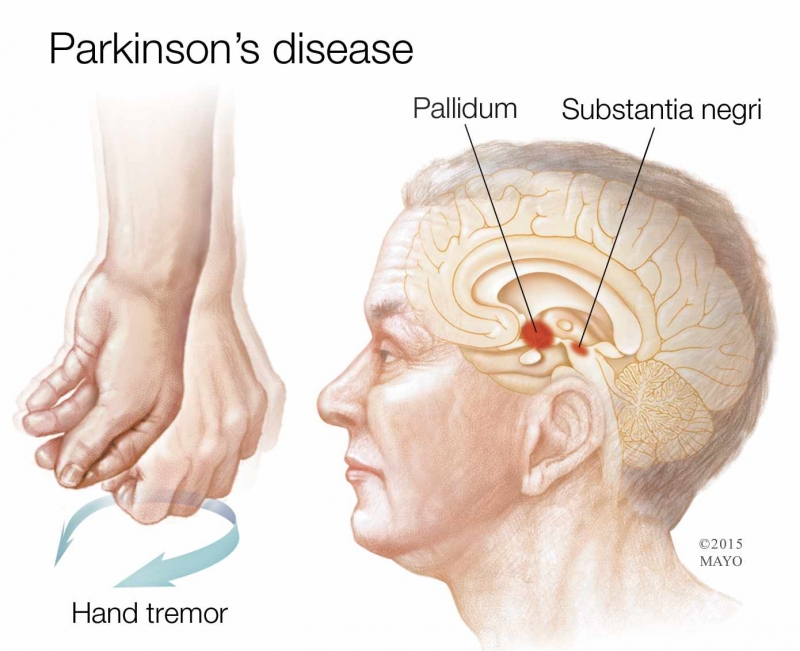 Parkinson Disease 