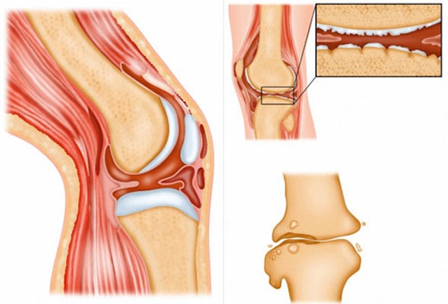 Chondromalacia Patella